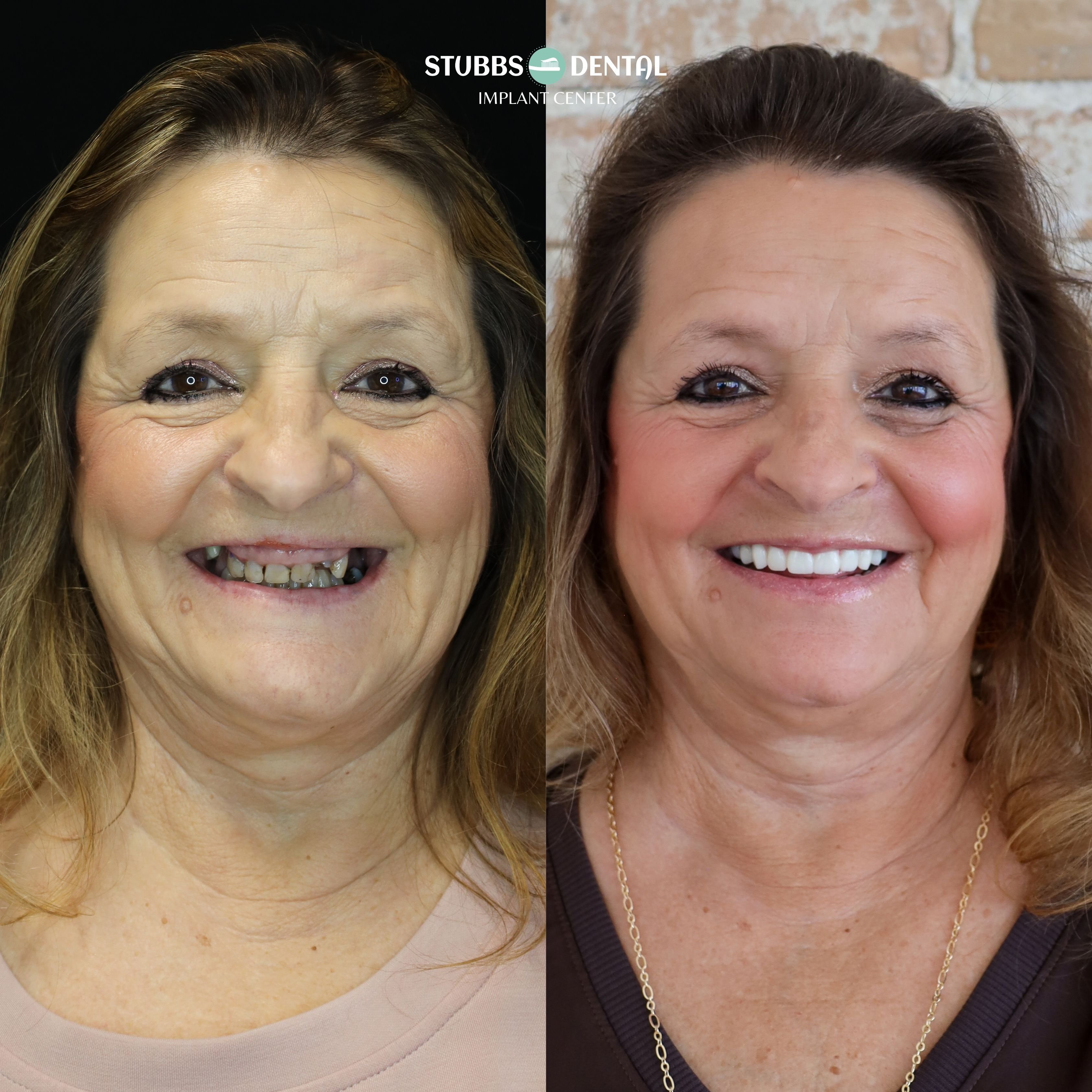 Dental Implant Before and After Stubbs Dental
