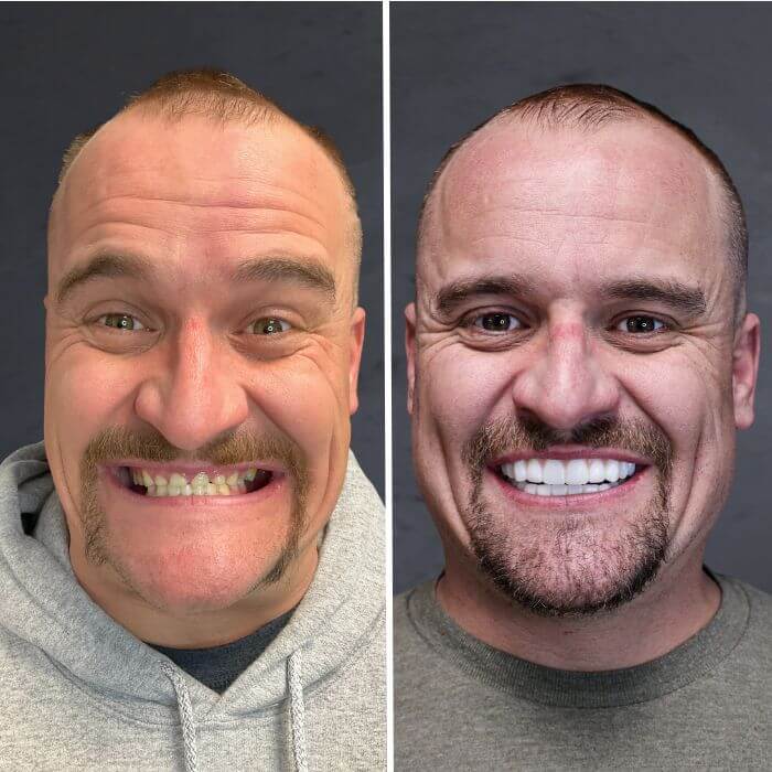 Before and after dental implants Riverton, UT