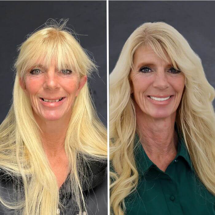 Before and after dental implants Layton, UT