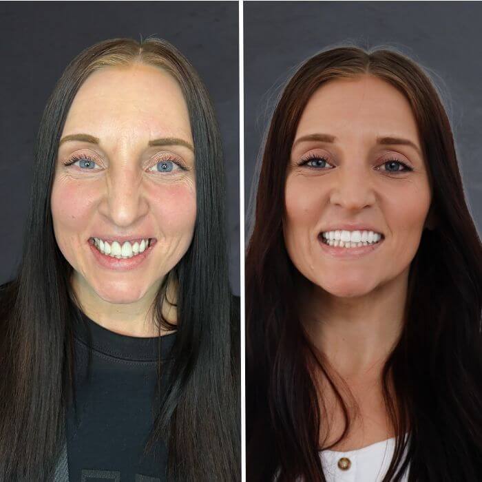 Before and after dental implants Layton, UT