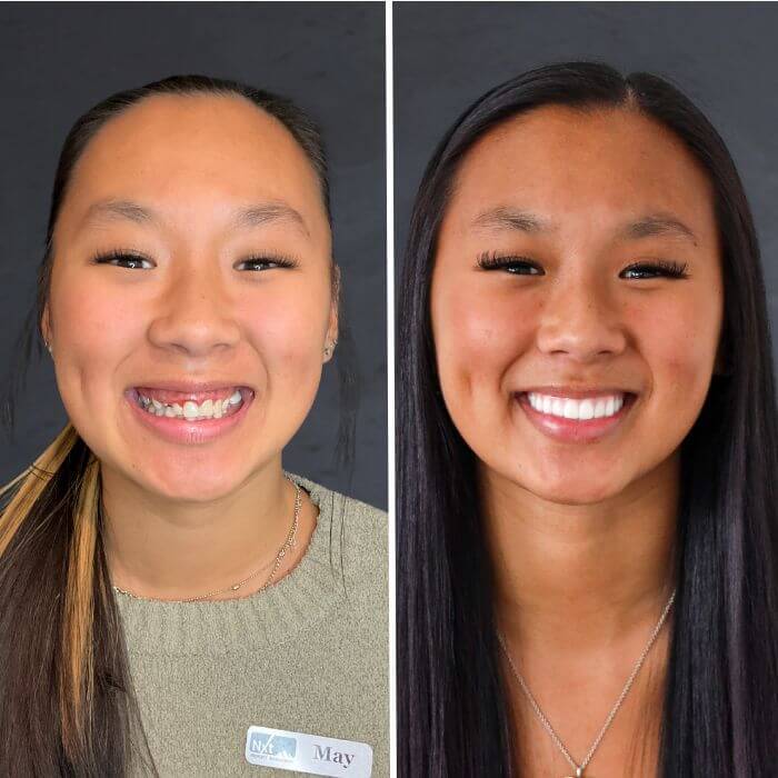 Before and after dental implants Draper, UT