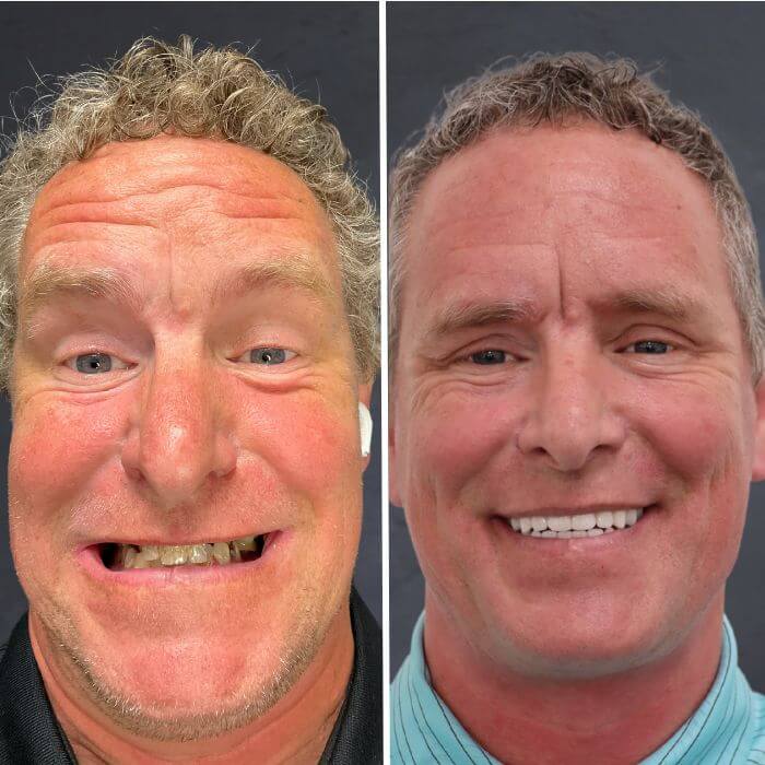 Before and after dental implants Odgen, UT