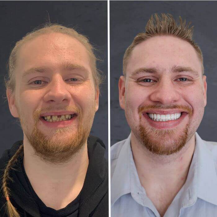 Before and after dental implants Kaysville, UT