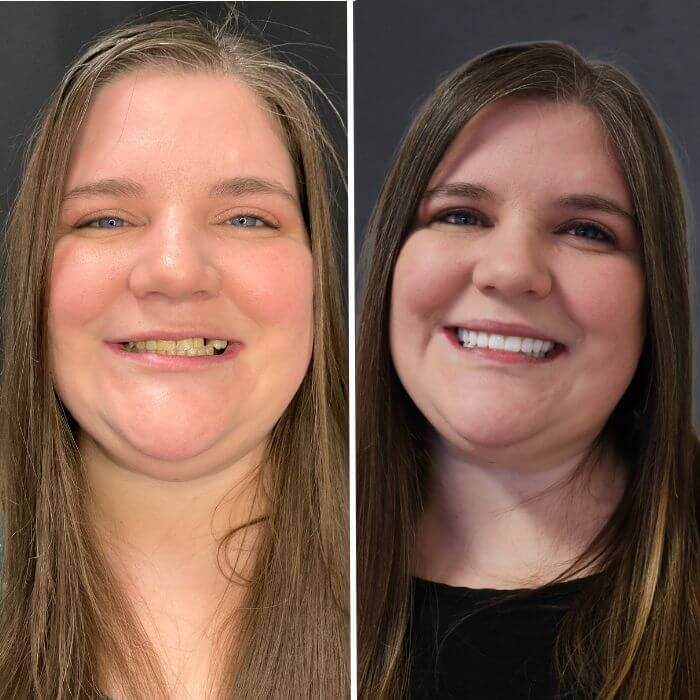 Before and after dental implants Sandy, UT