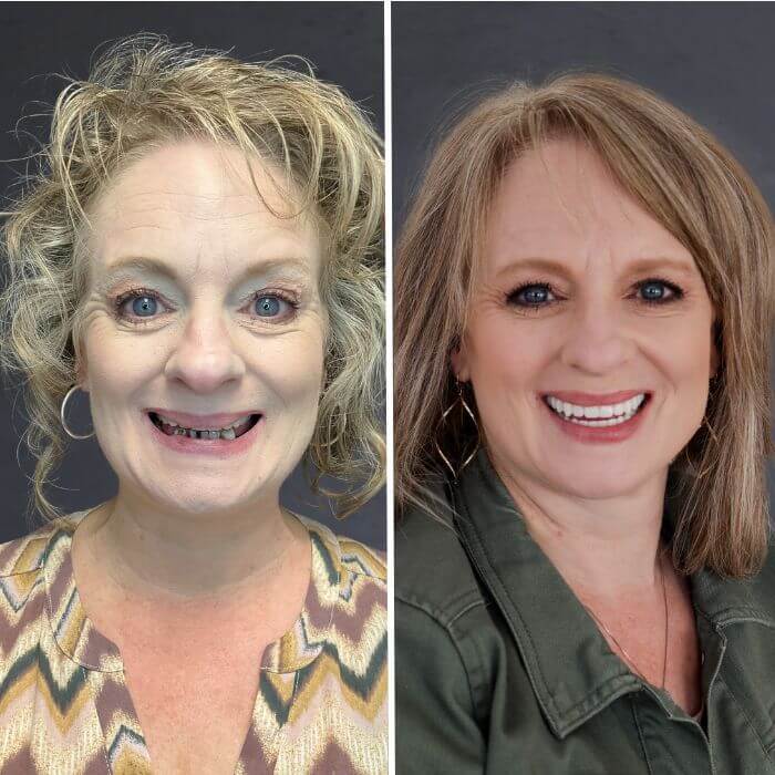 Before and after dental implants Farmington, UT