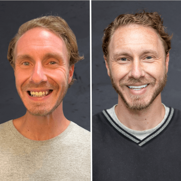 Before and after dental implant Stubbs Dental