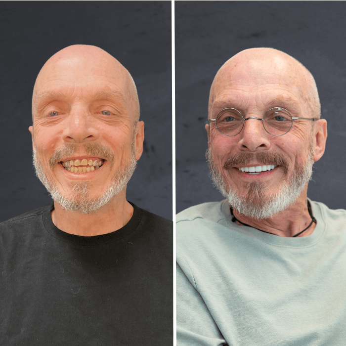 Before and after dental implant Stubbs Dental
