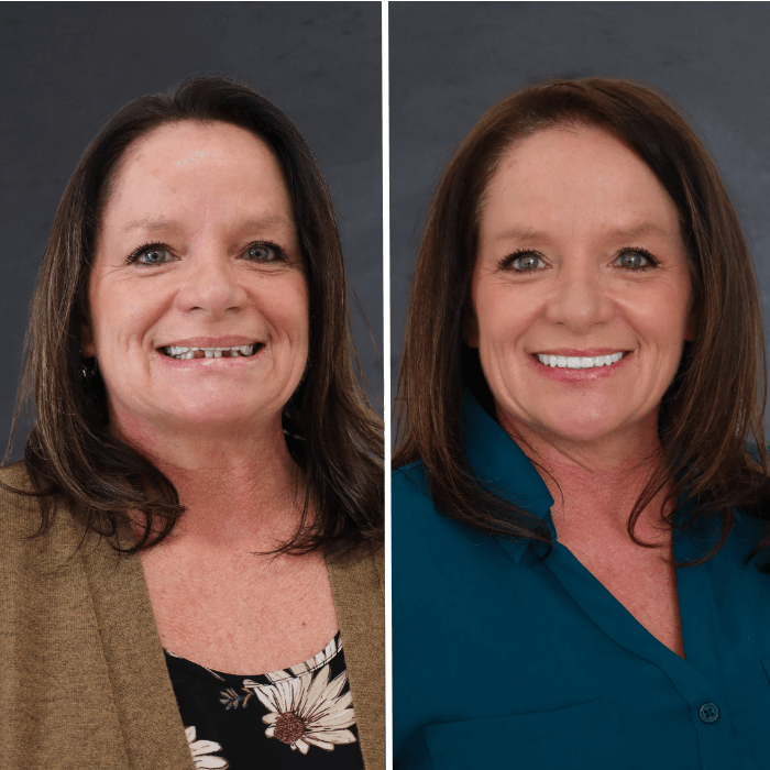 Before and after dental implant Stubbs Dental