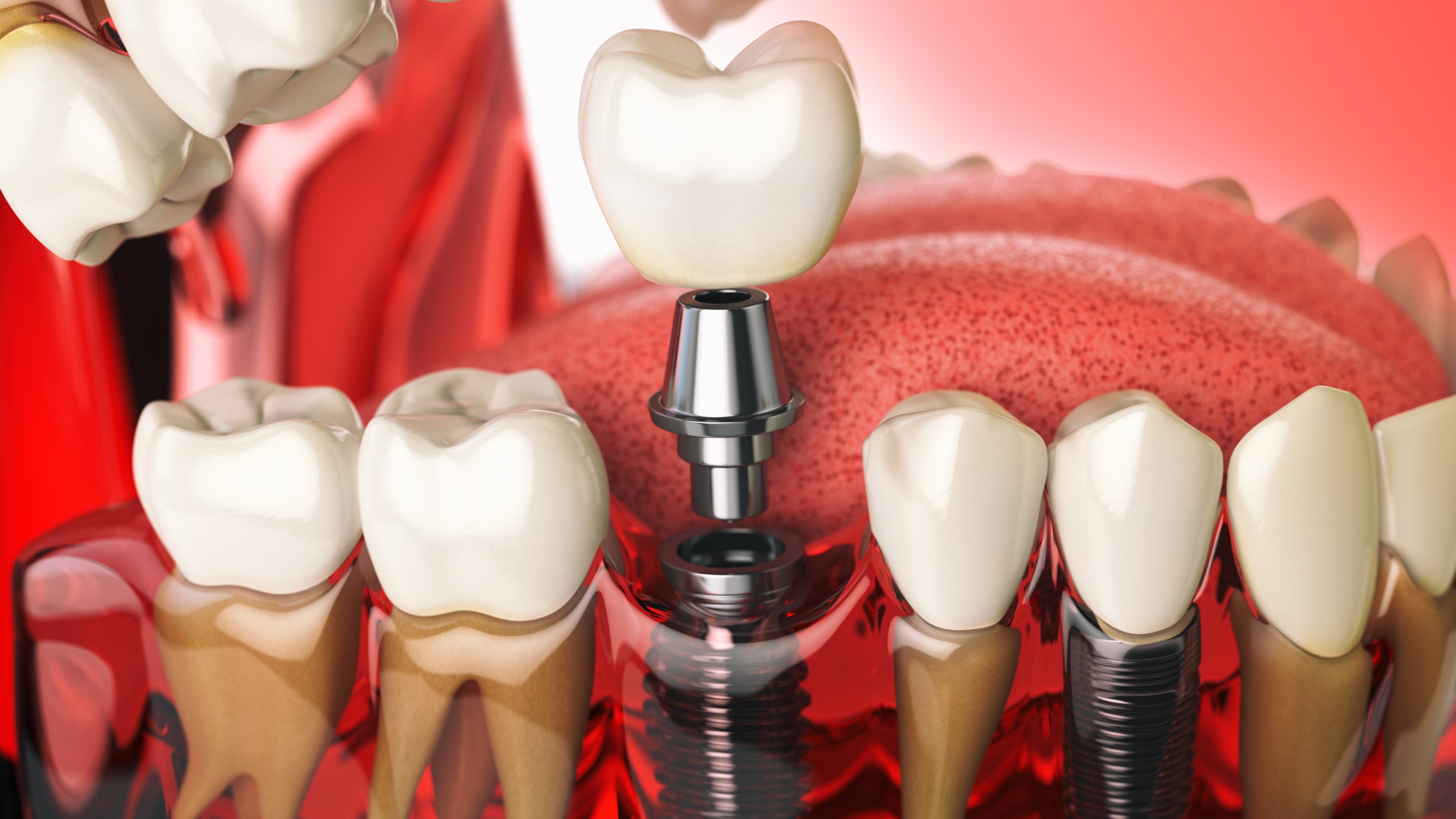 Dental Implants in Utah