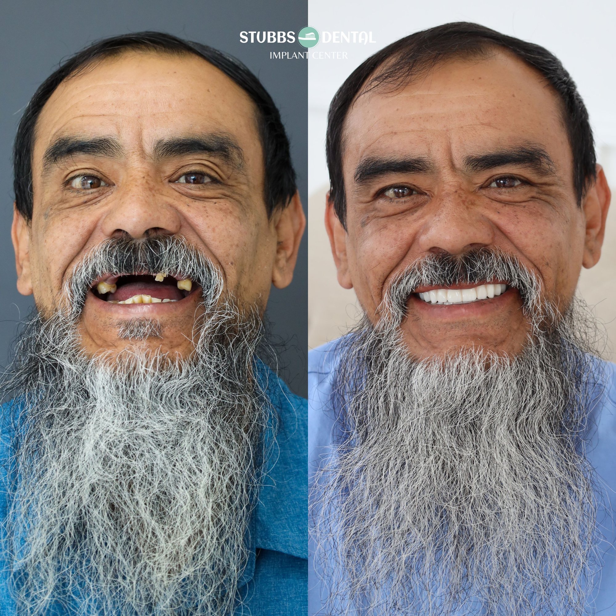Dental Implants at Stubbs Dental