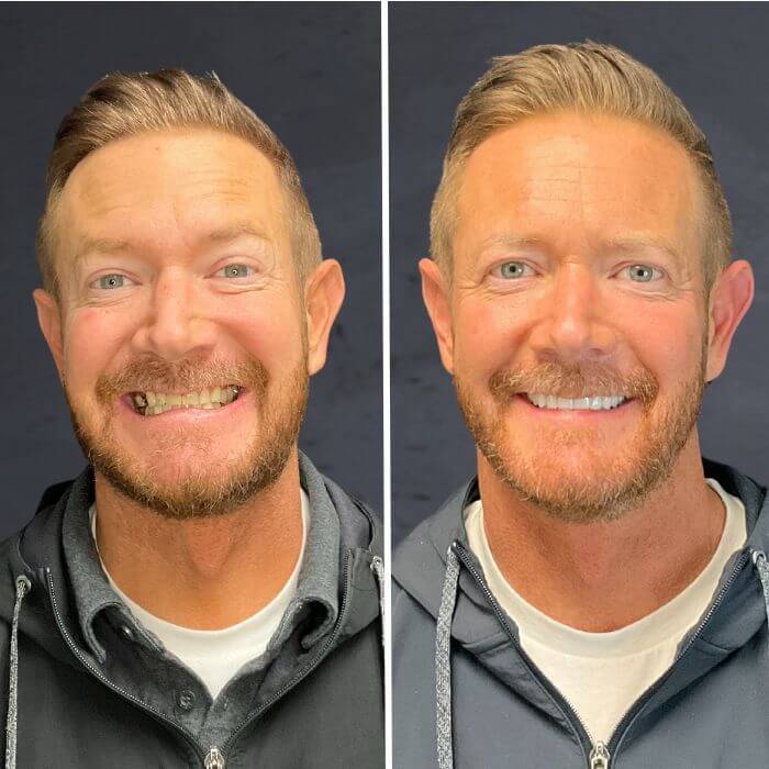 Before and after dental implants salt lake city, ut