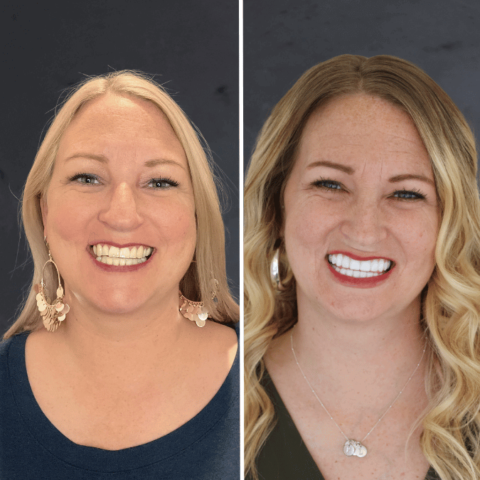 Before and after dental implants Bountiful, UT