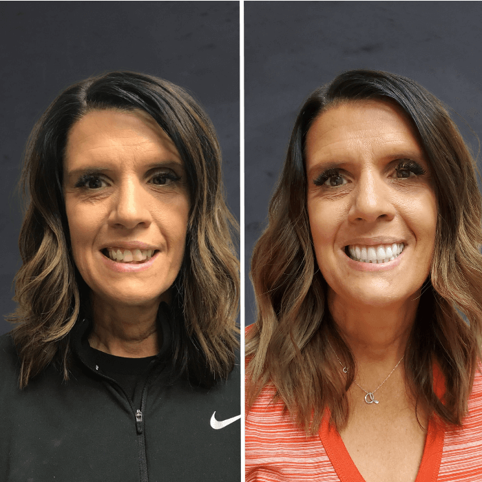 Before and after dental implants Salt Lake City, UT