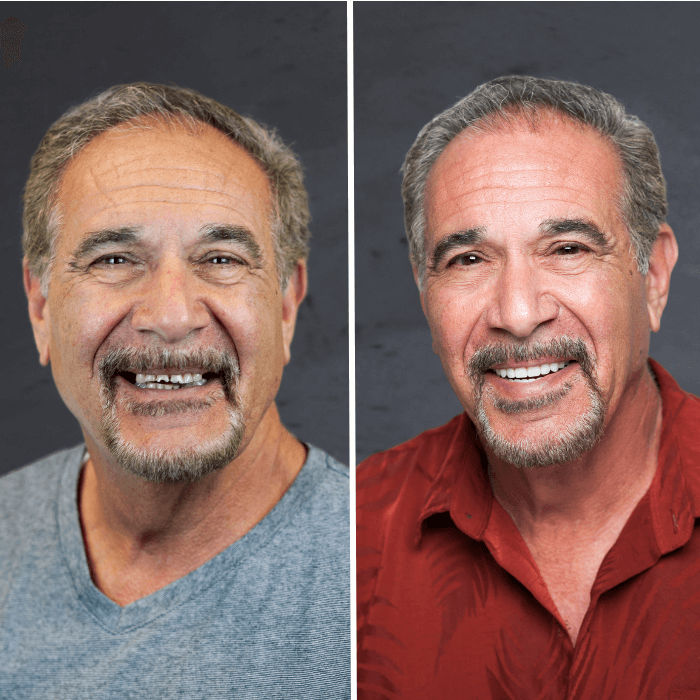 Before and after dental implants Layton, UT