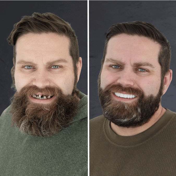 Before and after dental implants Draper, UT