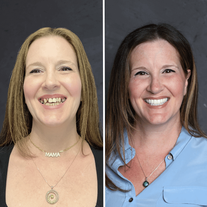 Before and after dental implants Ogden, UT