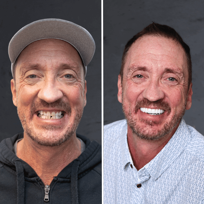 Before and after dental implants Murray, UT