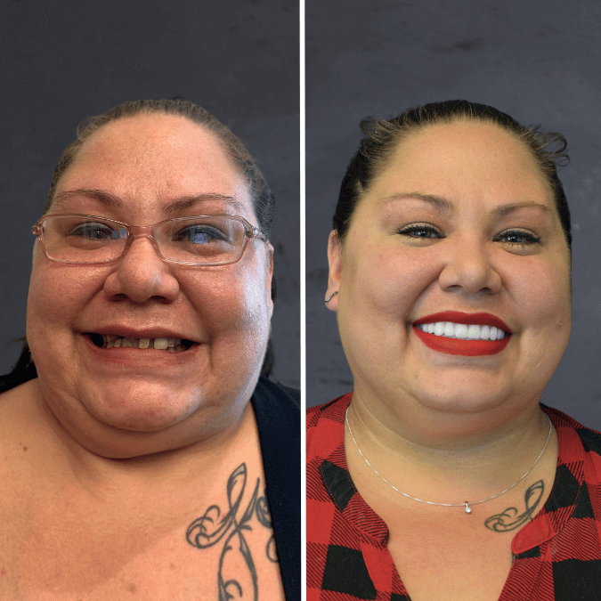 Before and after dental implants Layton, UT