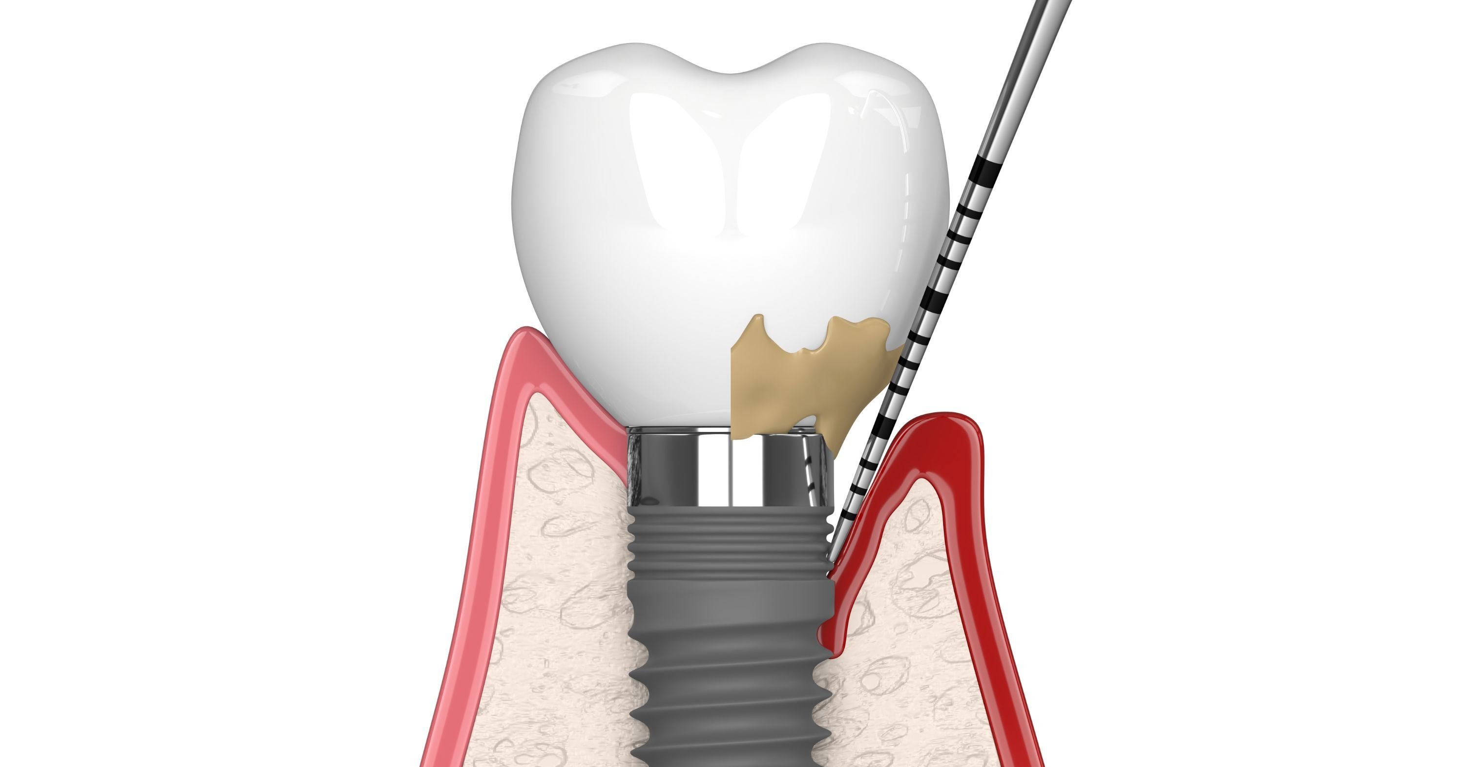 Plaque around dental implant