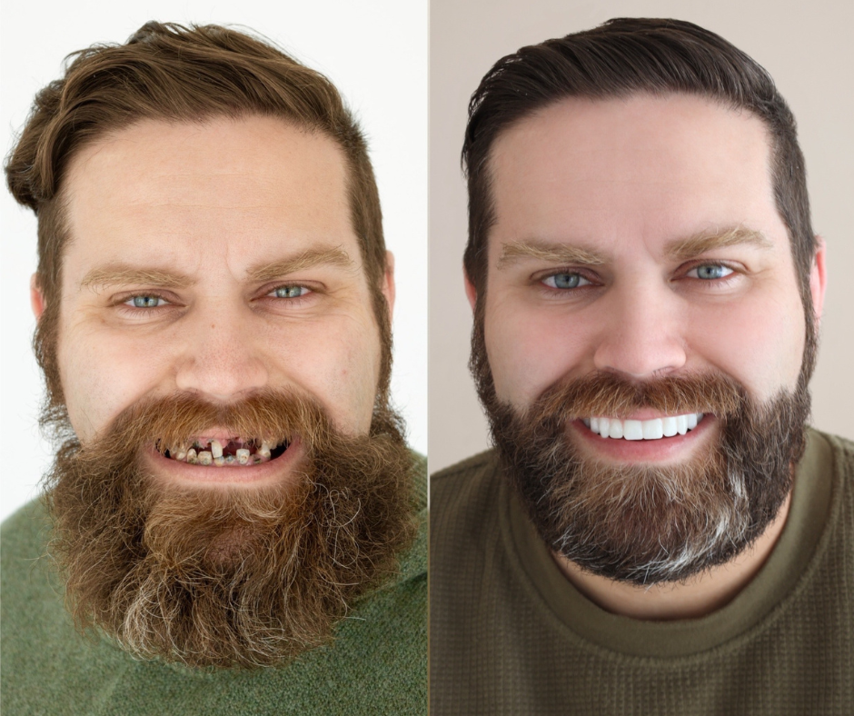 before and afters (1)
