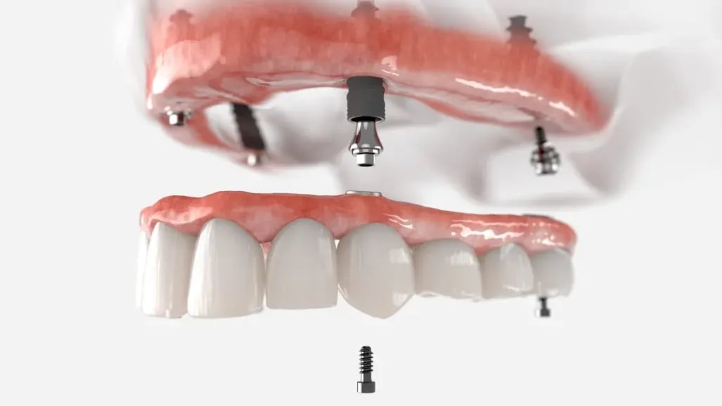 All-on-4 full mouth dental implants permanent denture 