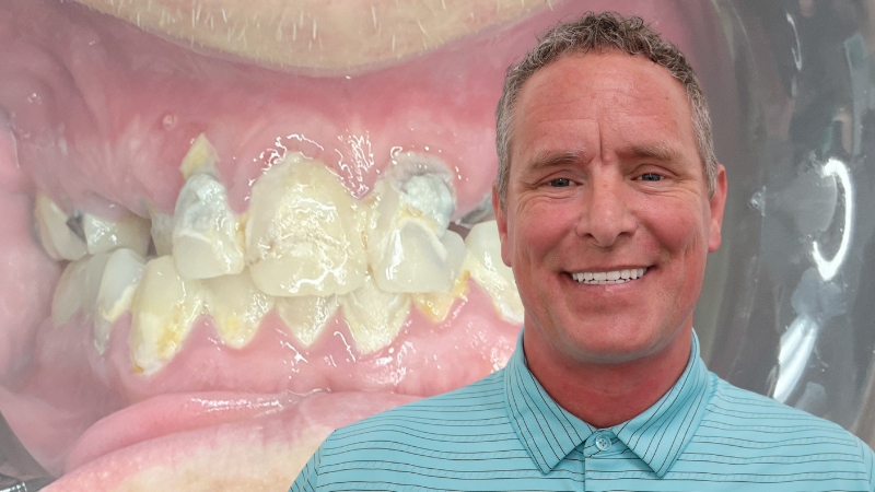 Full mouth dental implants 