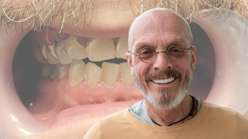 full mouth restoration Stubbs Dental