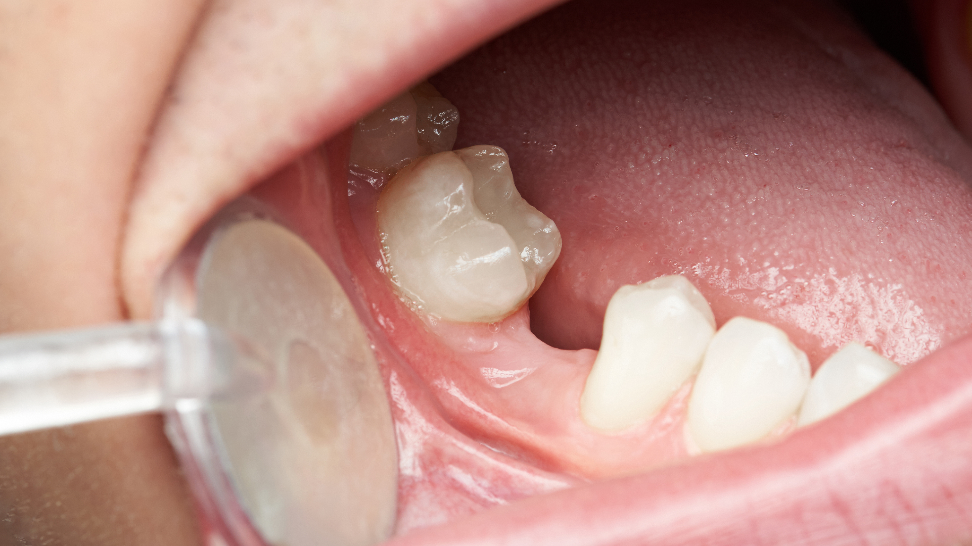 Patient with a missing tooth