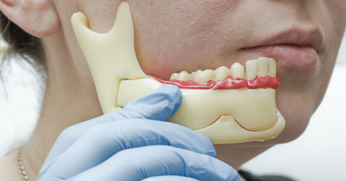 How Dental Implants Help Prevent Jawbone Loss