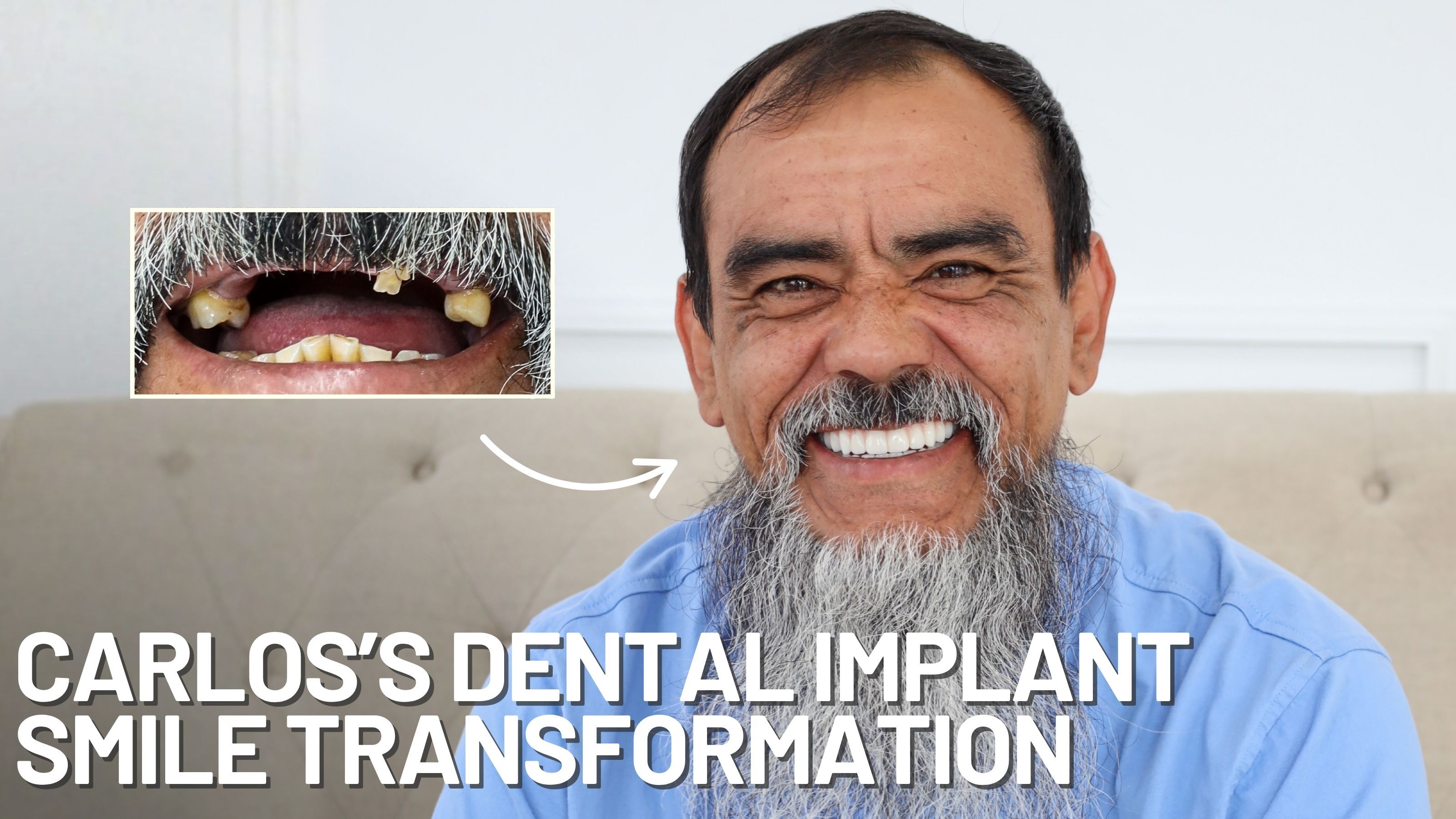 Carlos's All-on-X Dental Implant Smile Transformation at Stubbs Dental