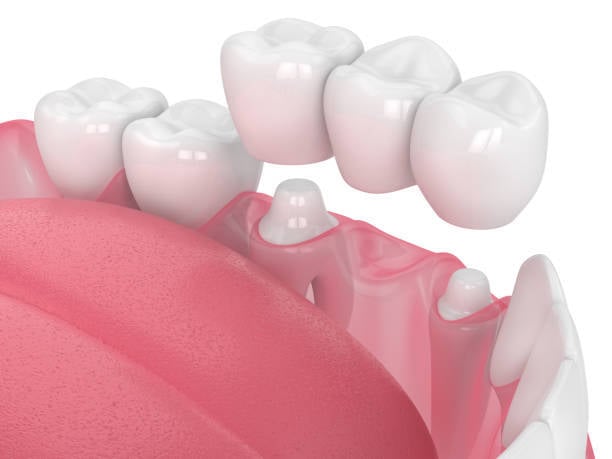Dental Bridge