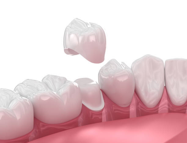 Dental Crown