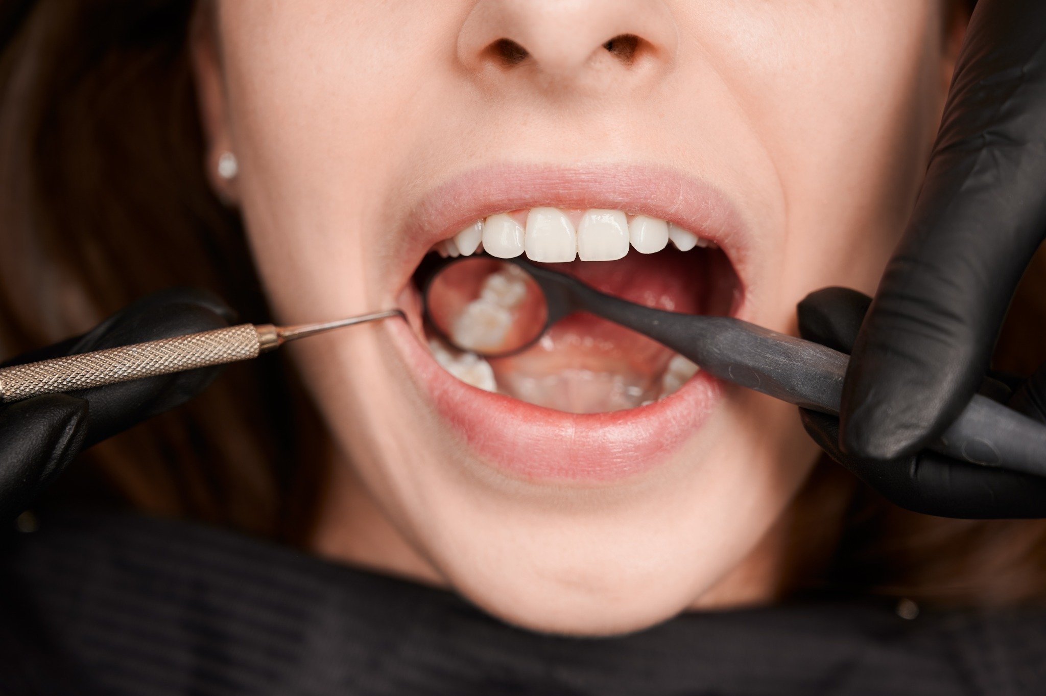 Dental Extractions Checkup