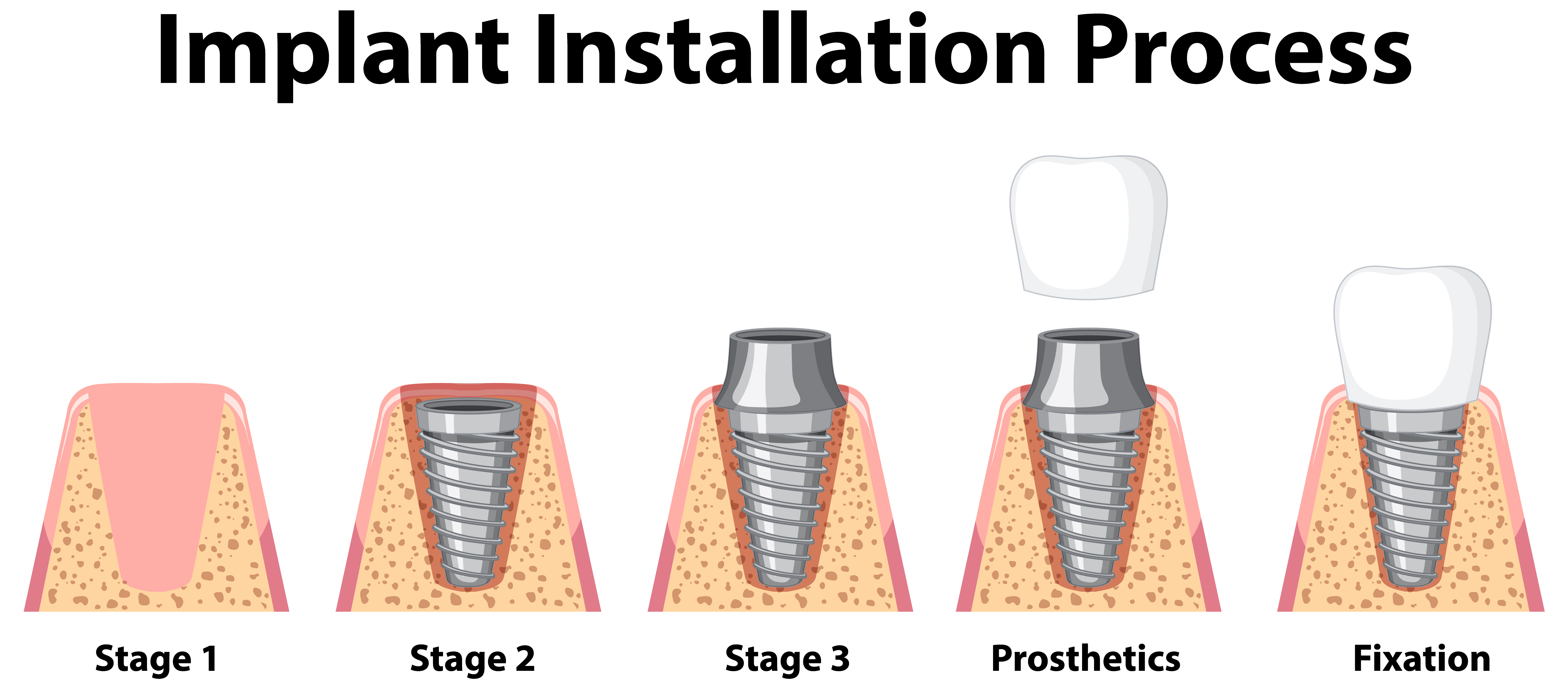 Dental implant process and steps