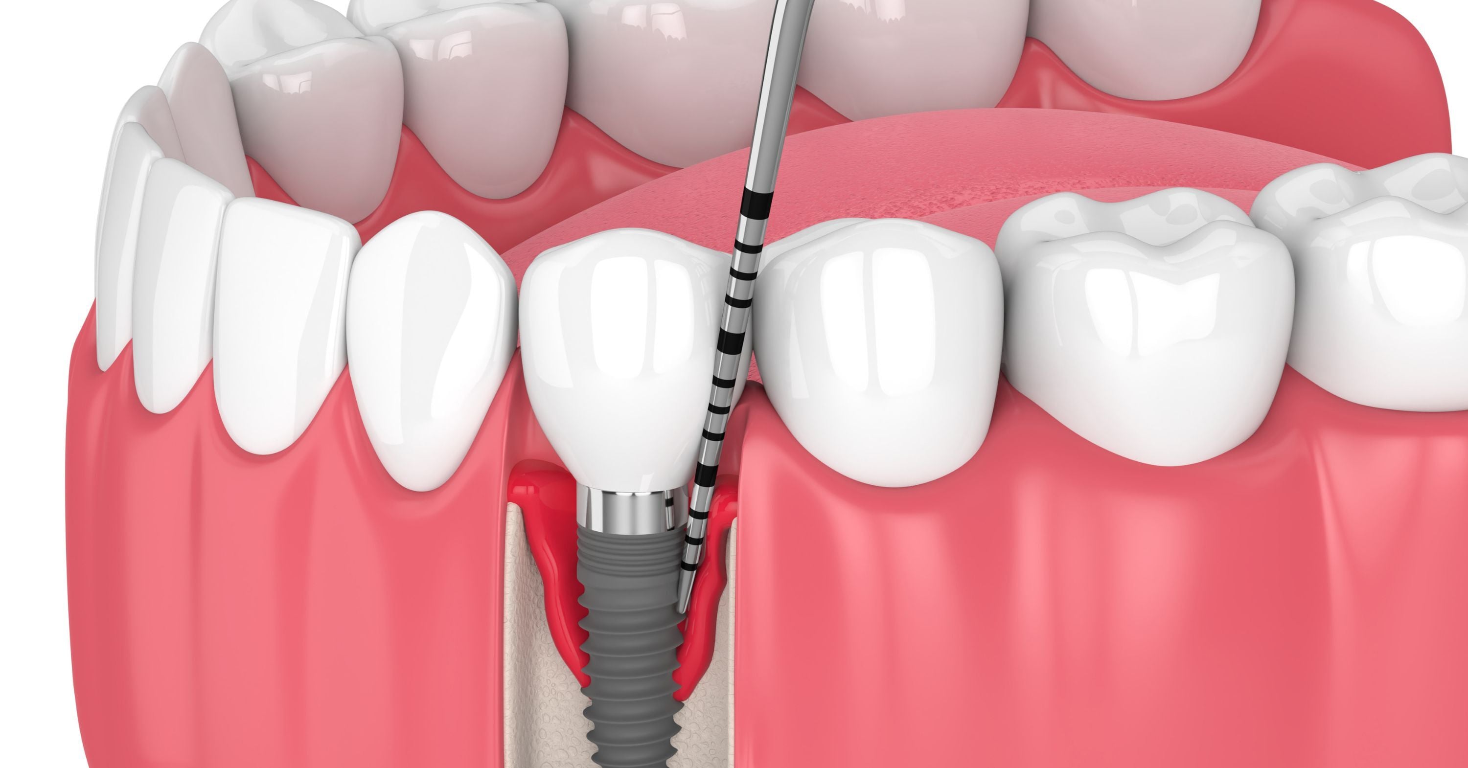 What causes peri-Implantitis and how to prevent it when getting dental implants