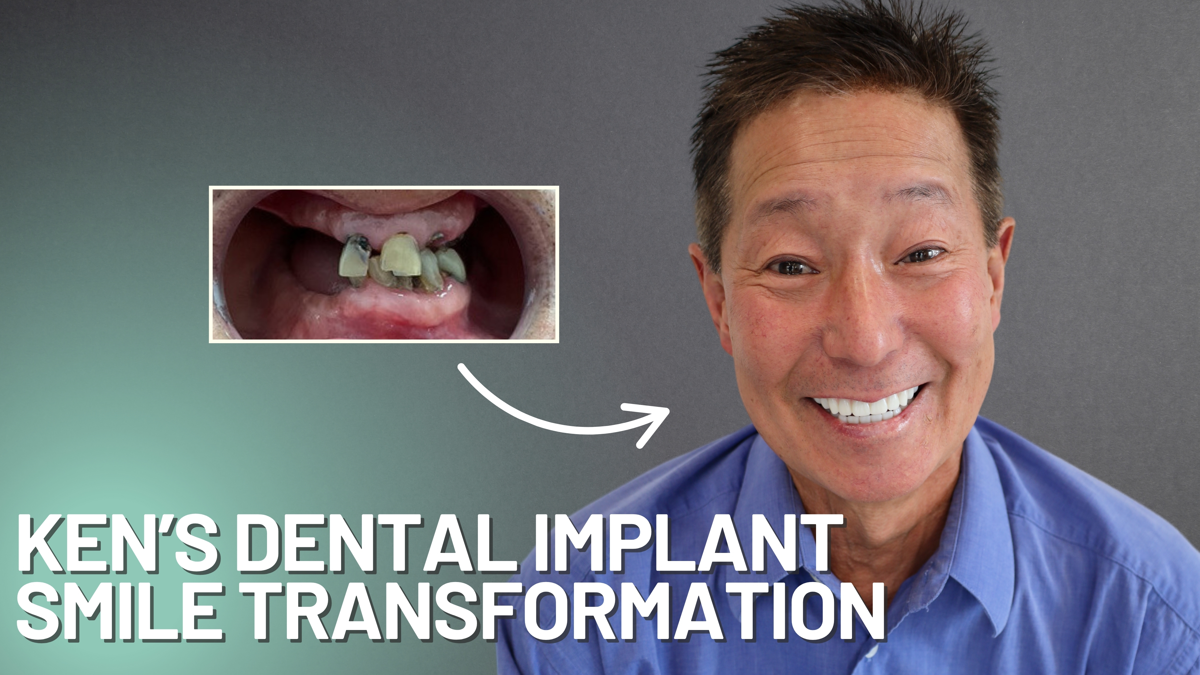 Ken's Dental Implant Smile Transformation