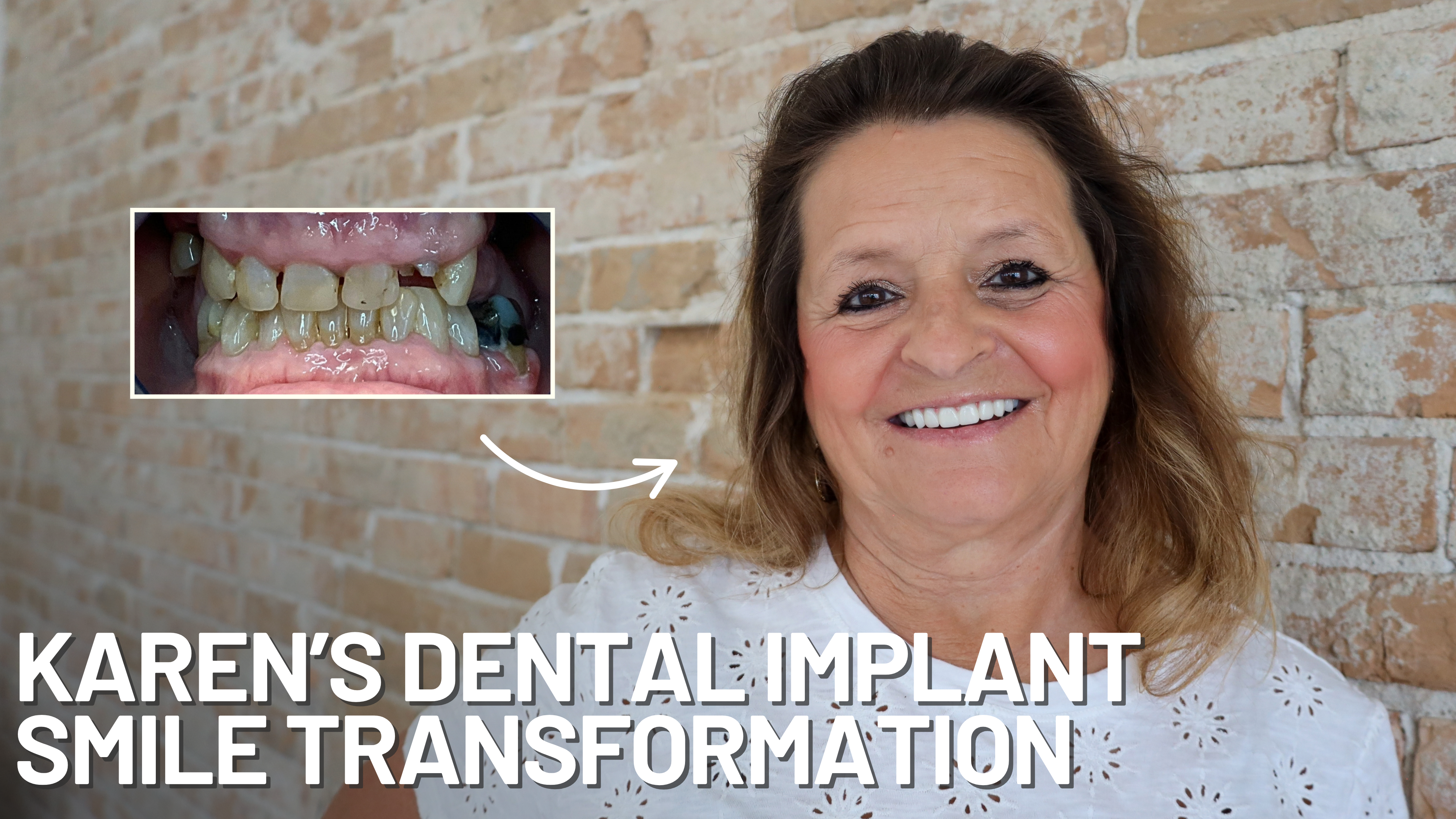 Karen's All-on-X Dental Implant Smile Transformation at Stubbs Dental Utah