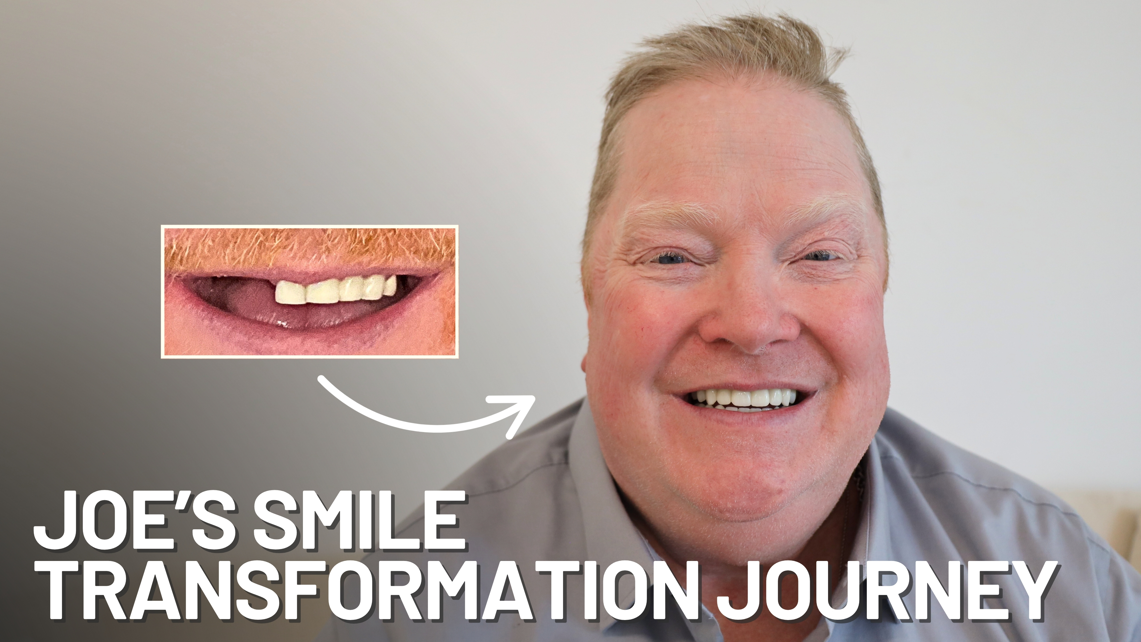 Joe's Dental Implant Smile Transformation Journey