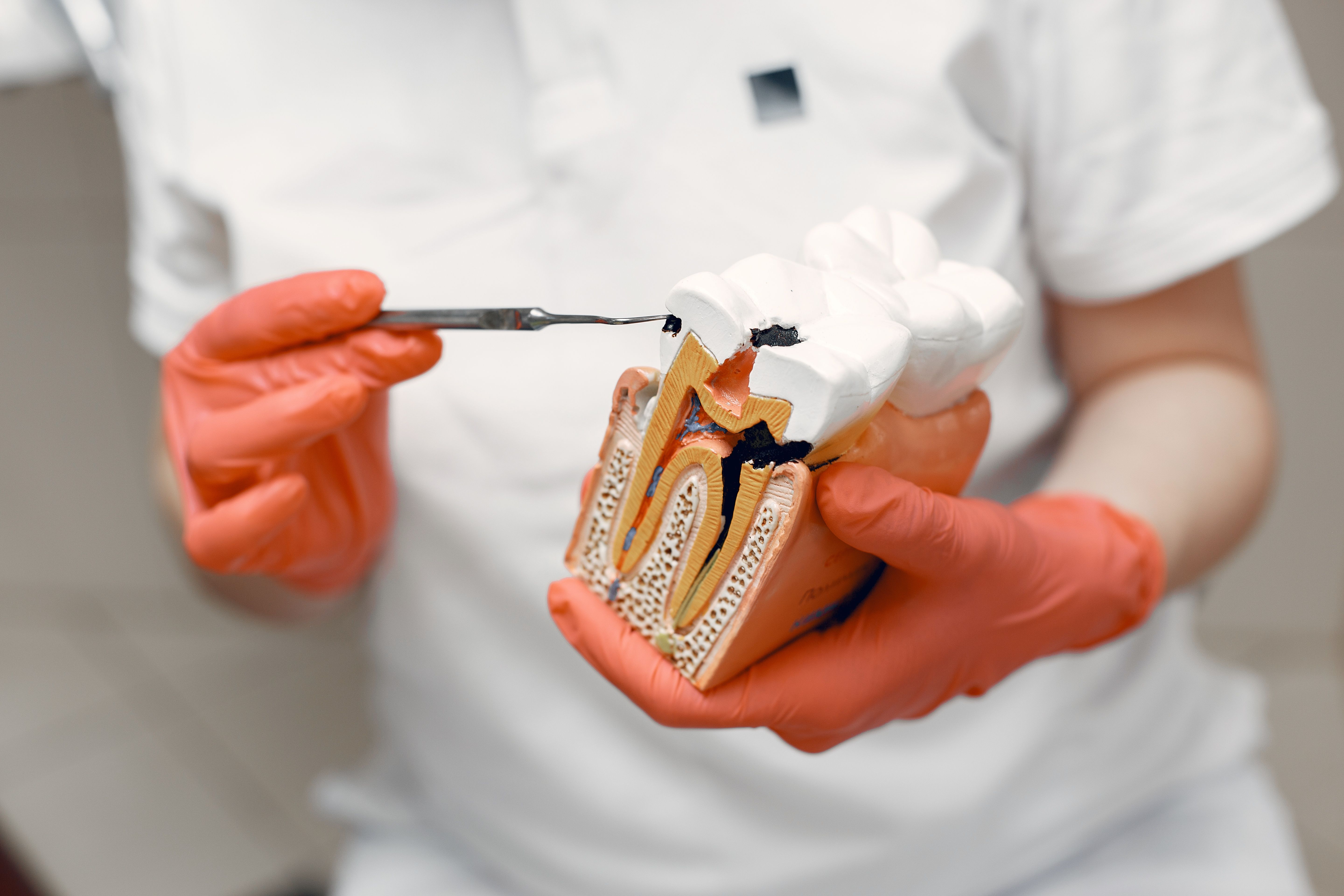 Dental crown and cavity filling at Stubbs Dental in Utah