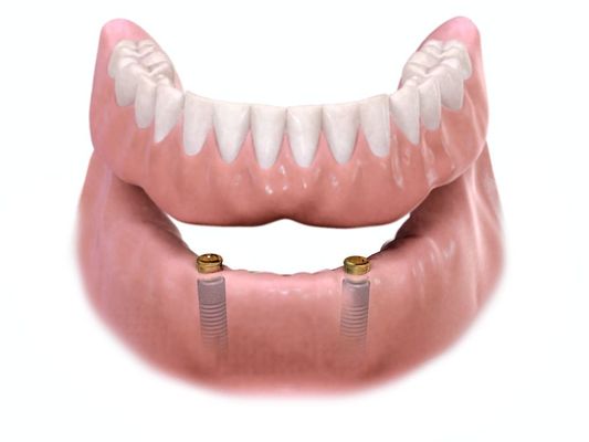 Snap on dental implant denture