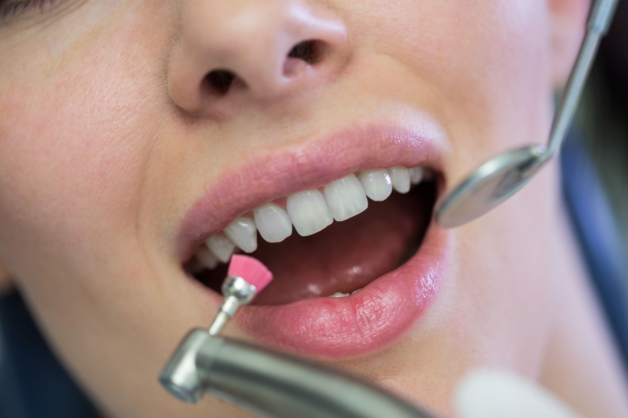stubbs dental teeth whitening patient in utah