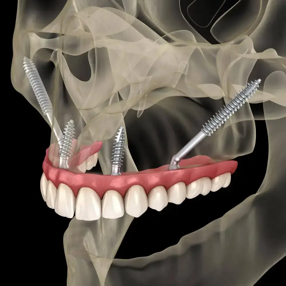 Zygomatic Implants at Stubbs Dental Implant Center